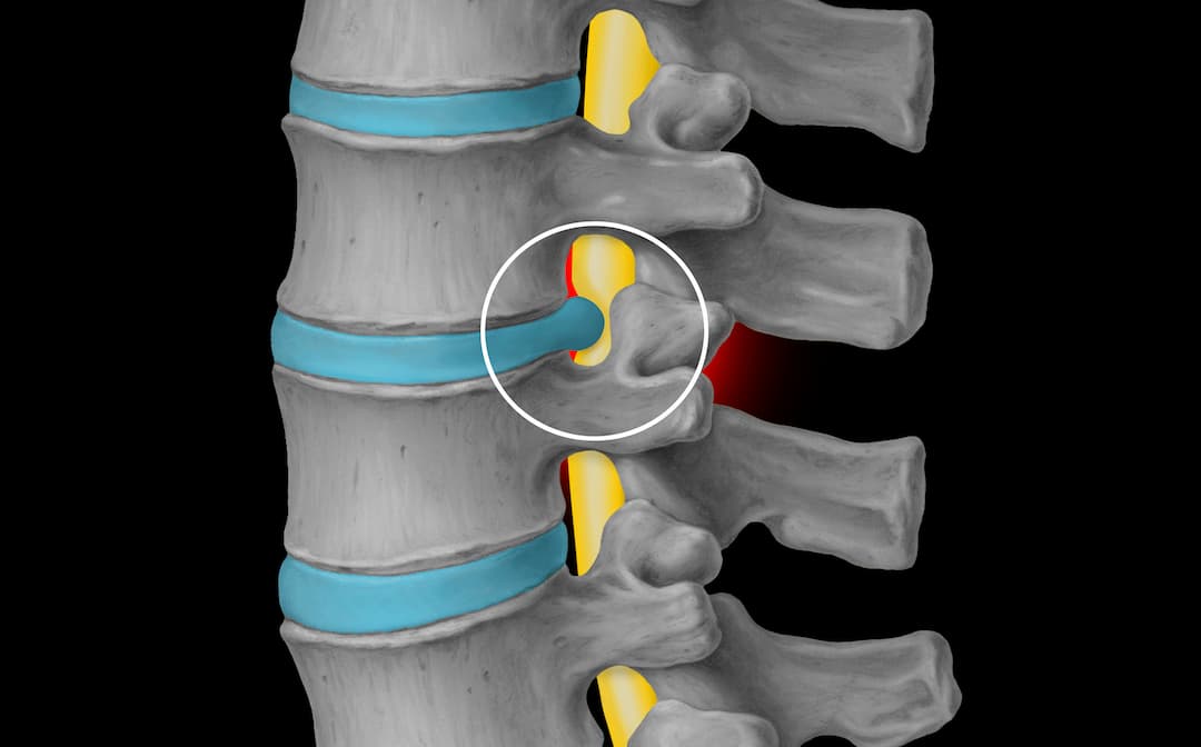 porcentaje de incapacidad por hernia de disco l5-s1